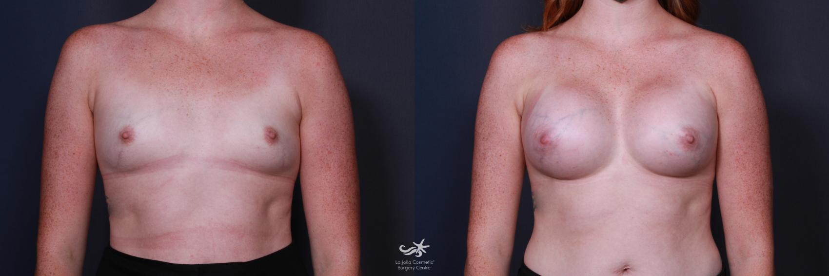 Before & After Breast Augmentation Result 208 Front View in San Diego, CA