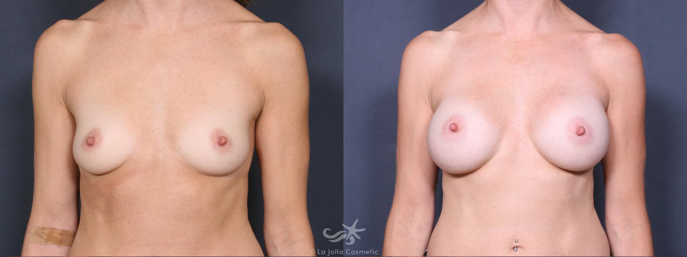 Before & After Breast Augmentation Result 266 Front View in San Diego, CA
