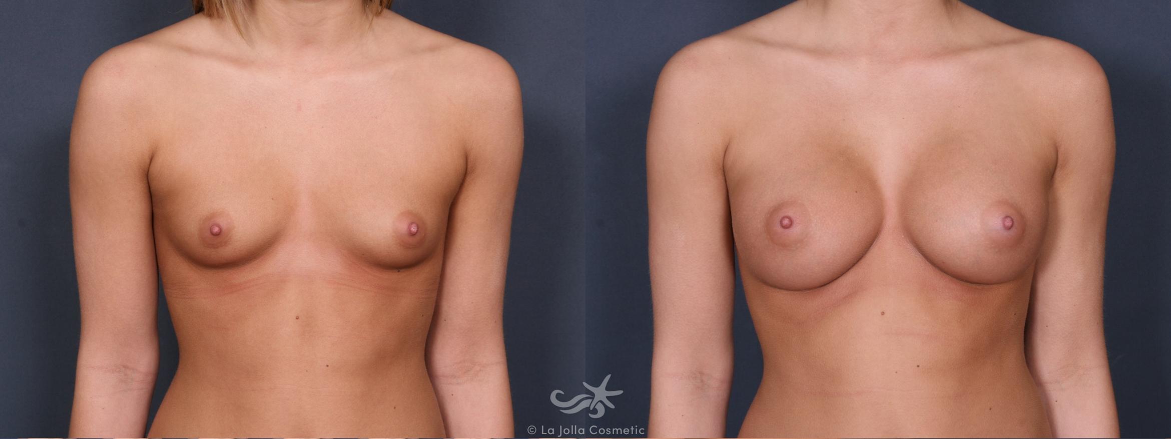 Before & After Breast Augmentation Result 271 Front View in San Diego, CA