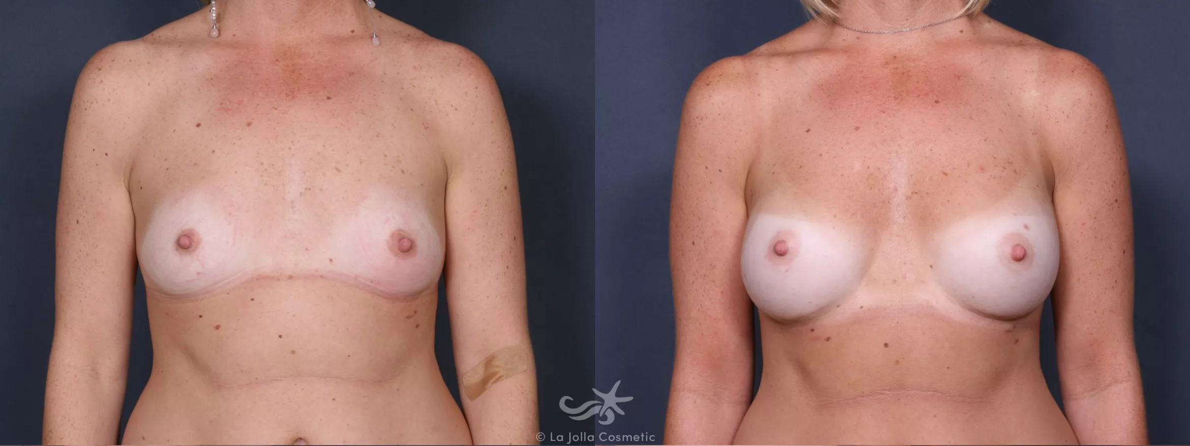 Before & After Breast Augmentation Result 297 Front View in San Diego, CA