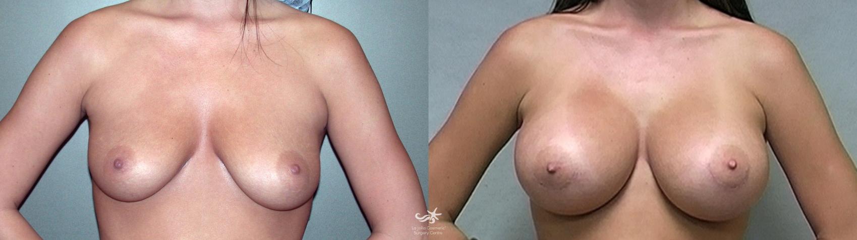 Before & After Breast Augmentation Result 321 Front View in San Diego, CA