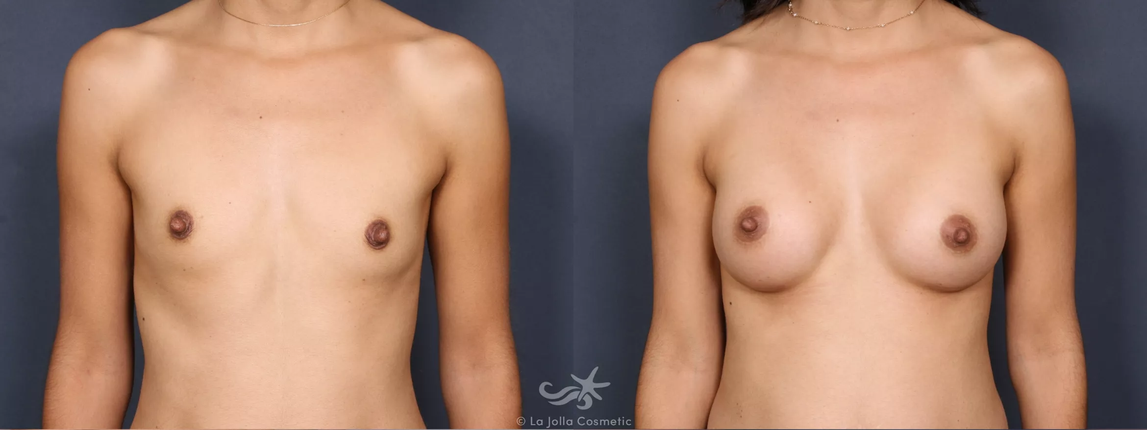 Before & After Breast Augmentation Result 387 Front View in San Diego, CA