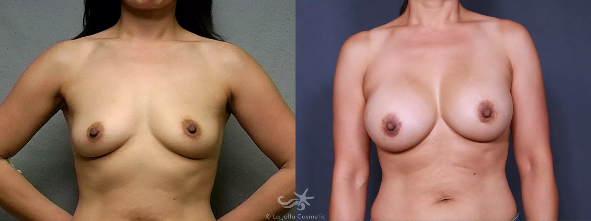 Before & After Breast Augmentation Result 448 Front View in San Diego, CA