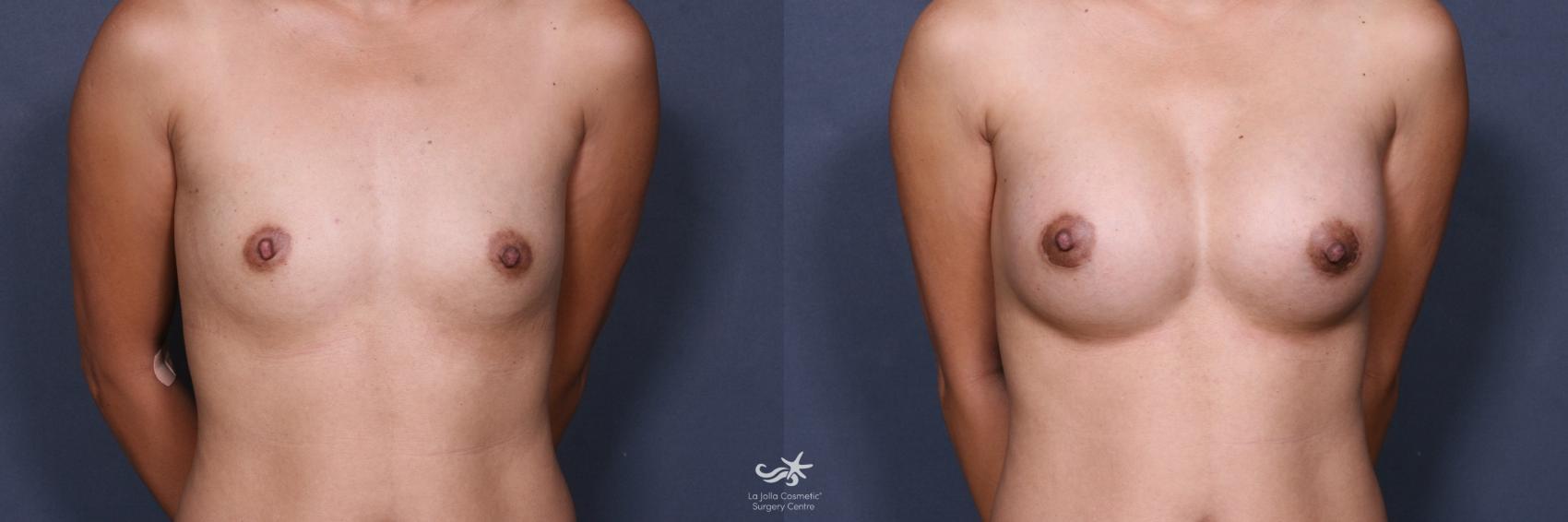 Before & After Breast Augmentation Result 461 Front View in San Diego, CA
