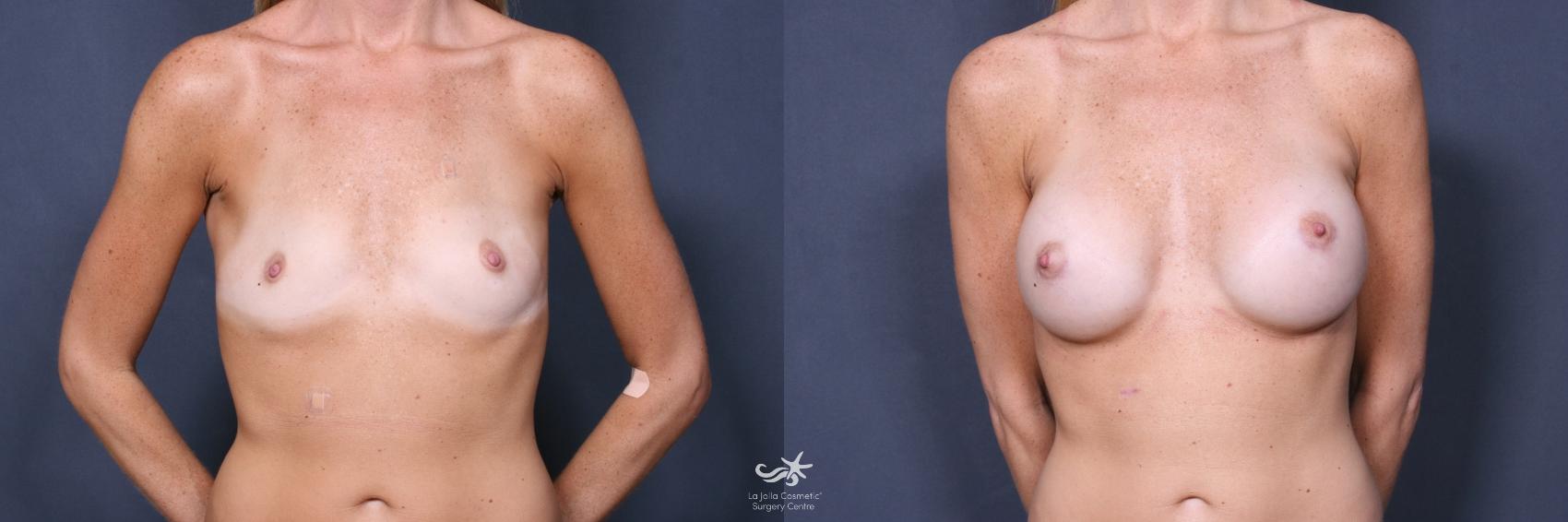 Before & After Breast Augmentation Result 532 Front View in San Diego, CA