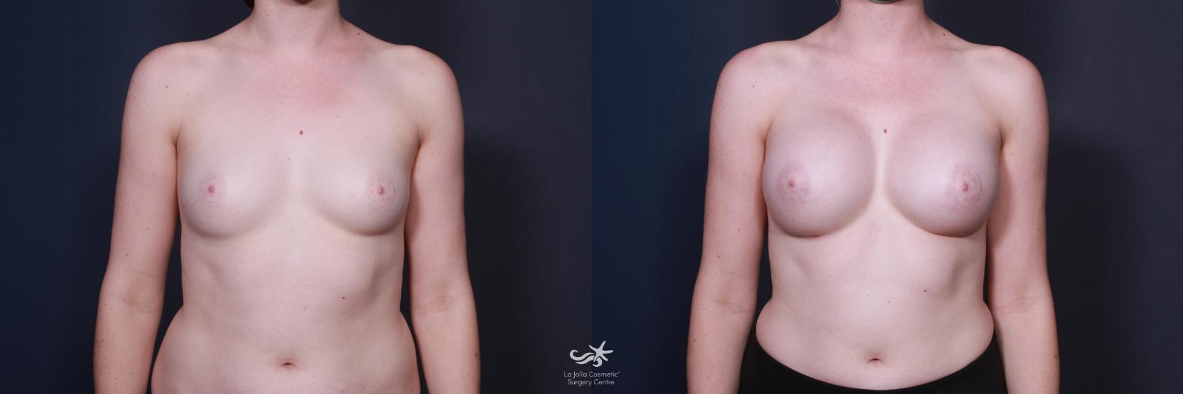 Before & After Breast Augmentation Result 60 Front View in San Diego, CA