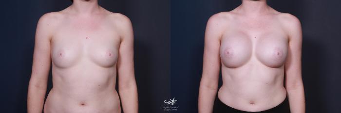 Before & After Breast Augmentation Result 60 Front View in San Diego, Carlsbad, CA