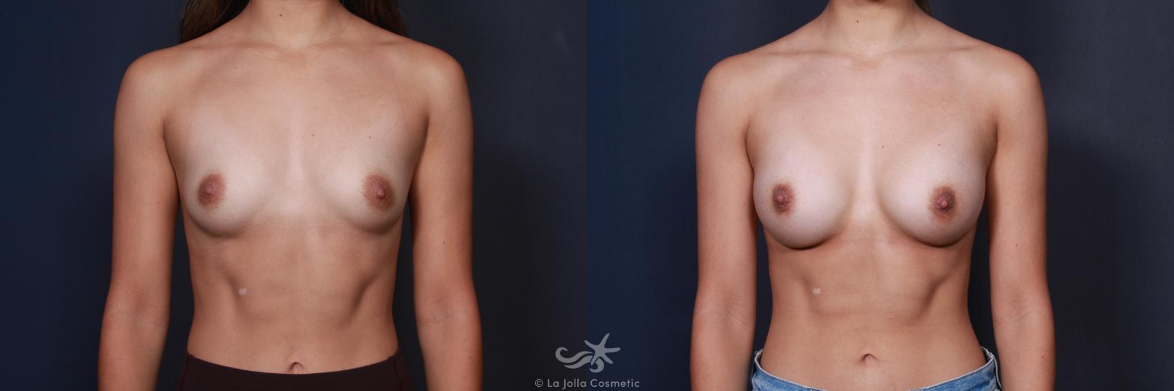 Before & After Breast Augmentation Result 61 Front View in San Diego, CA