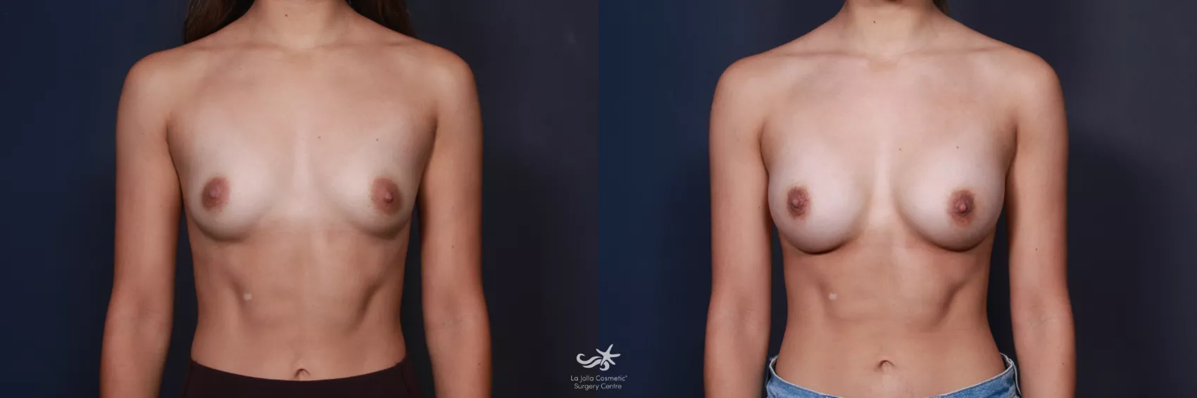 Before & After Breast Augmentation Result 61 Front View in San Diego, CA