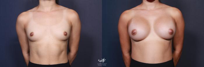 Before & After Breast Augmentation Result 88 Front View in San Diego, Carlsbad, CA