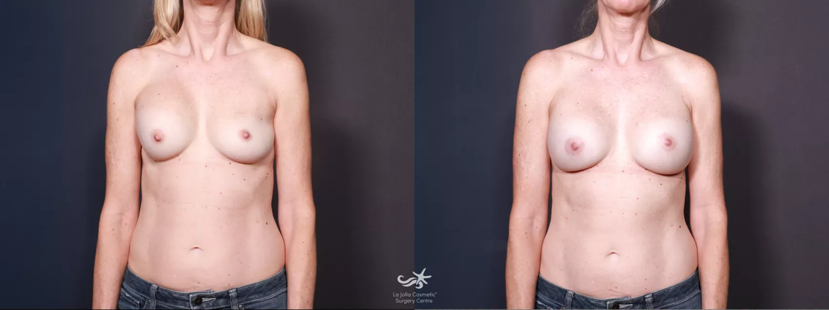 Before & After Revision Breast Surgery Result 618 Front View in San Diego, CA