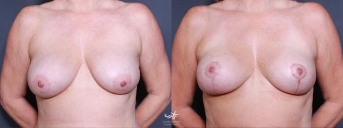 Before & After Breast Lift Result 497 Front View in San Diego, Carlsbad, CA