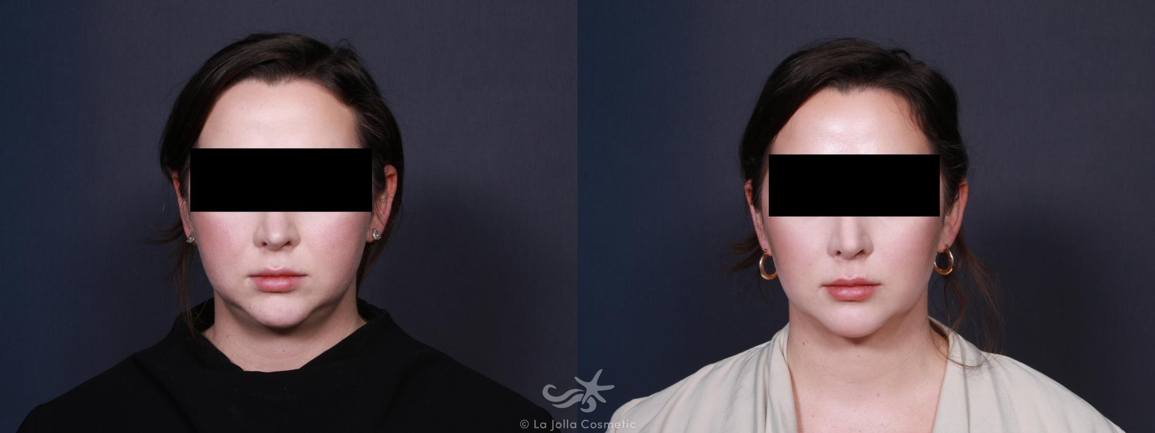 Before & After Buccal Fat Pad Removal Result 34 Front View in San Diego, CA
