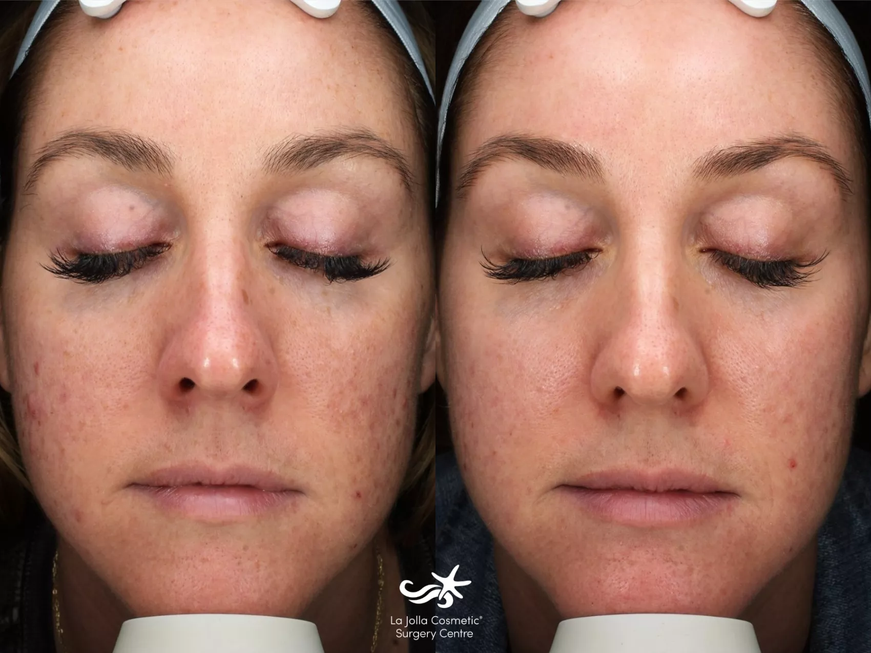 Before & After Chemical Peels Result 734 Front View in San Diego, CA