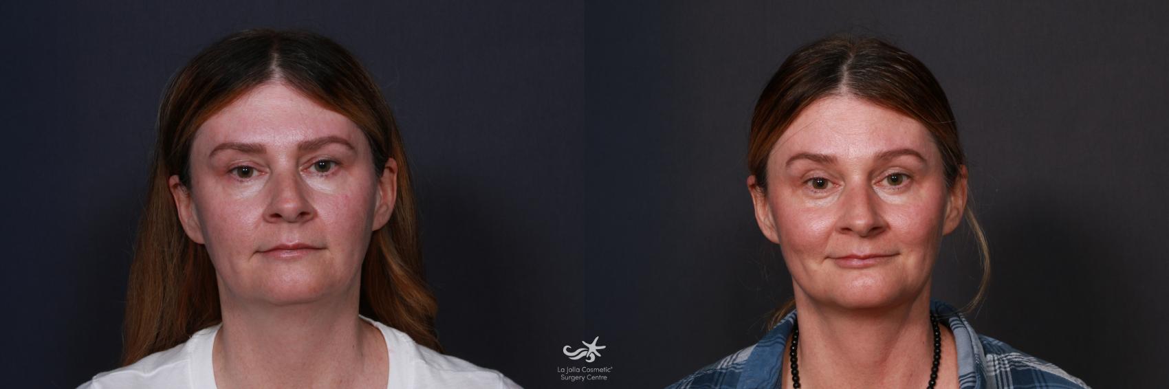 Before & After Neck Liposuction Result 211 Front View in San Diego, CA