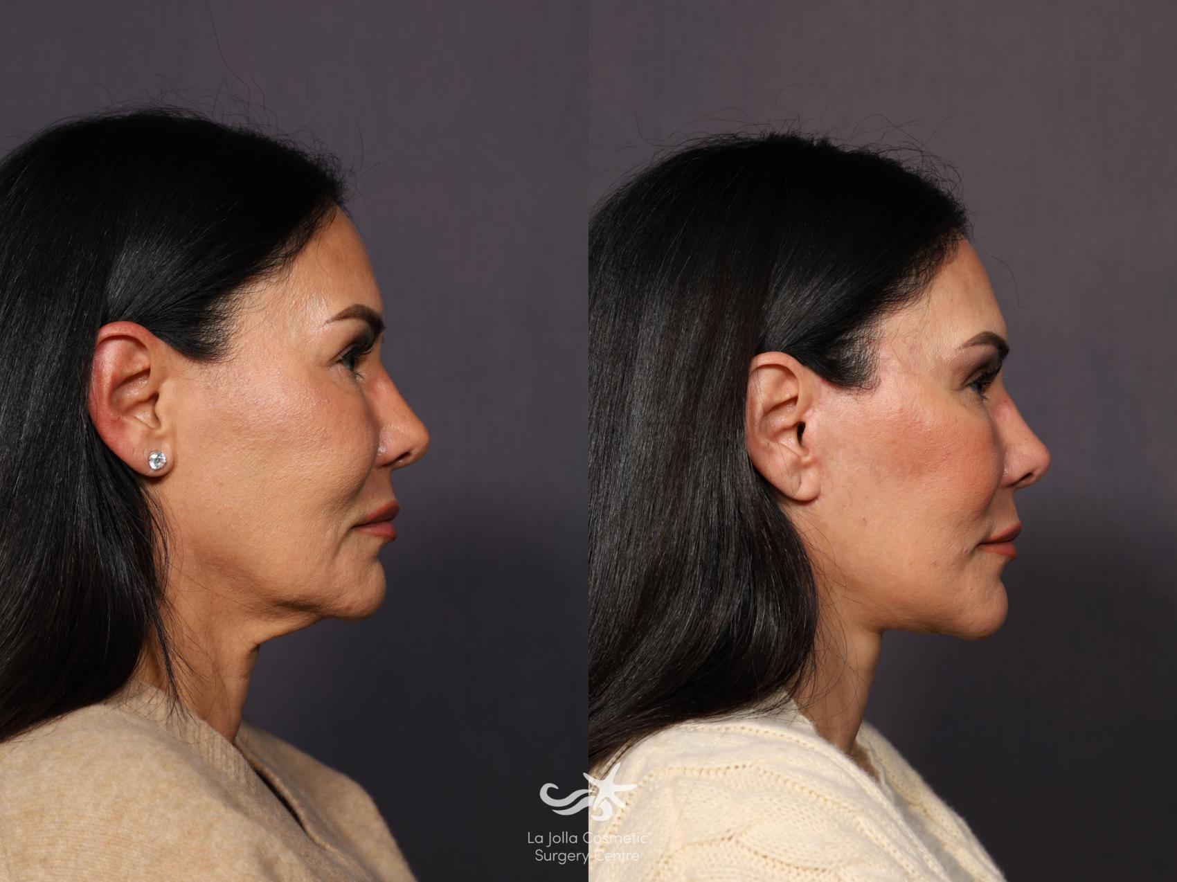 Before & After Deep Plane Facelift Result 1171 Right Side View in San Diego, CA