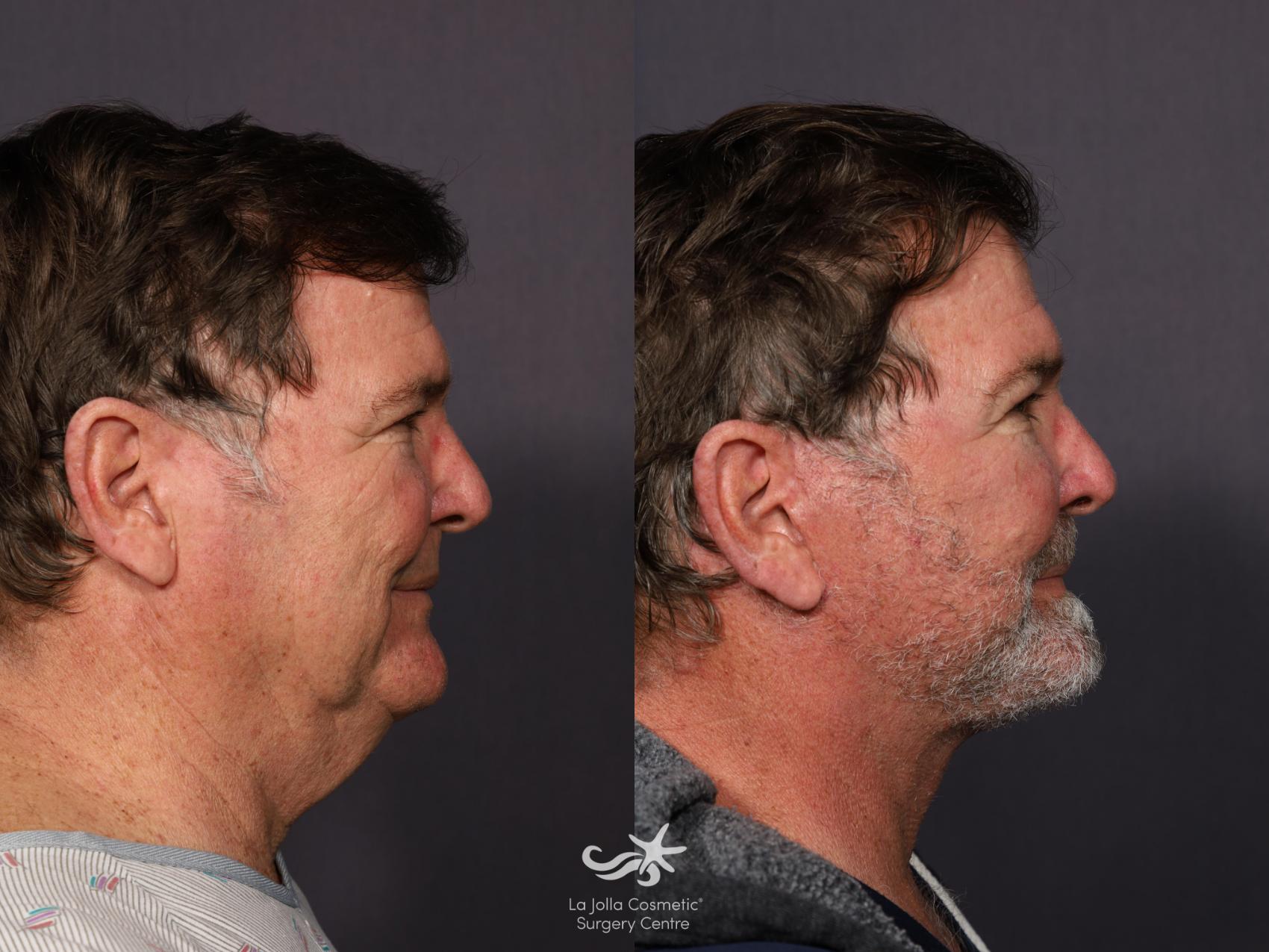 Before & After Deep Plane Facelift Result 1275 Right Side View in San Diego, CA