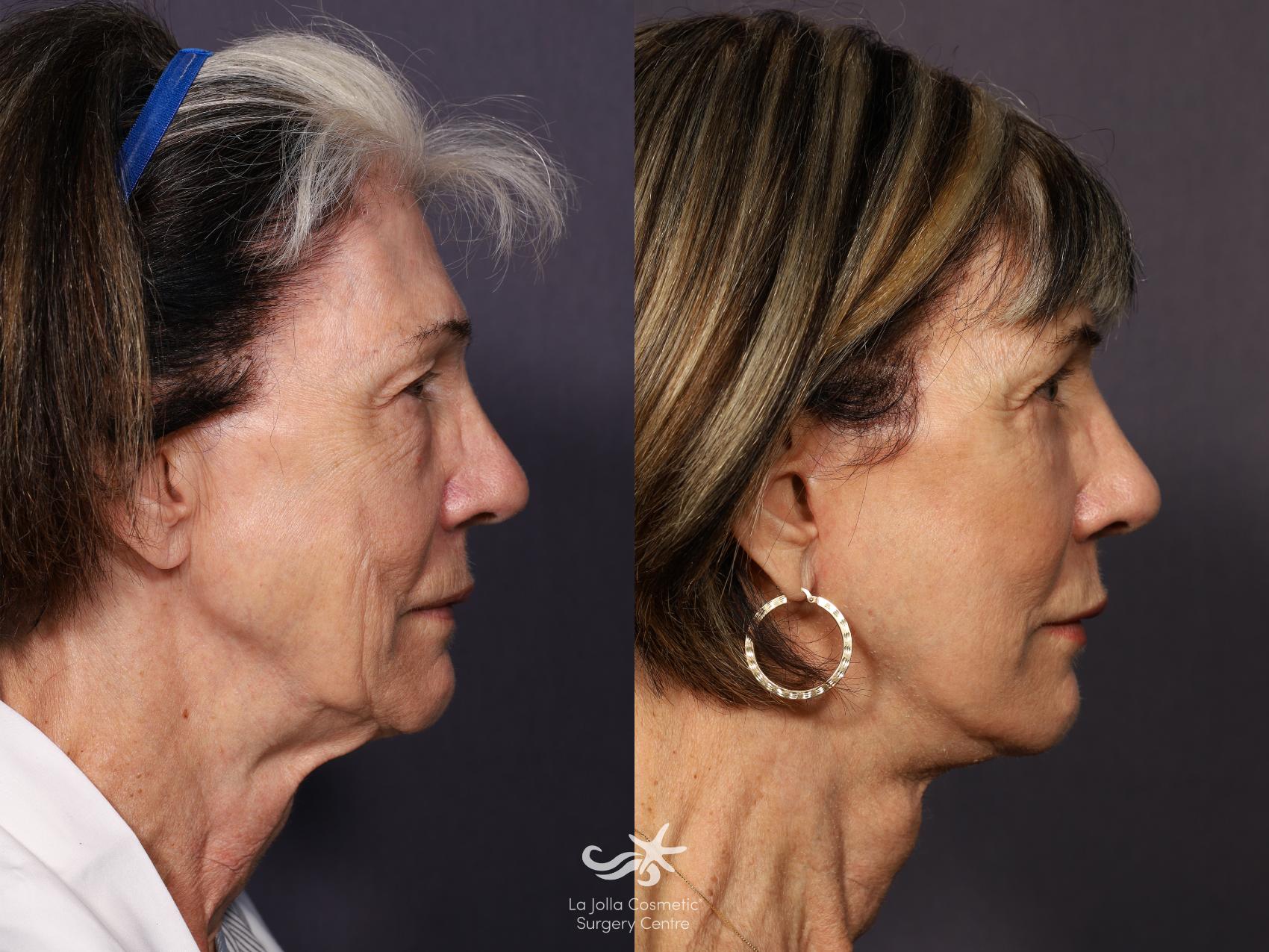 Before & After Deep Plane Facelift Result 722 Right Side View in San Diego, CA