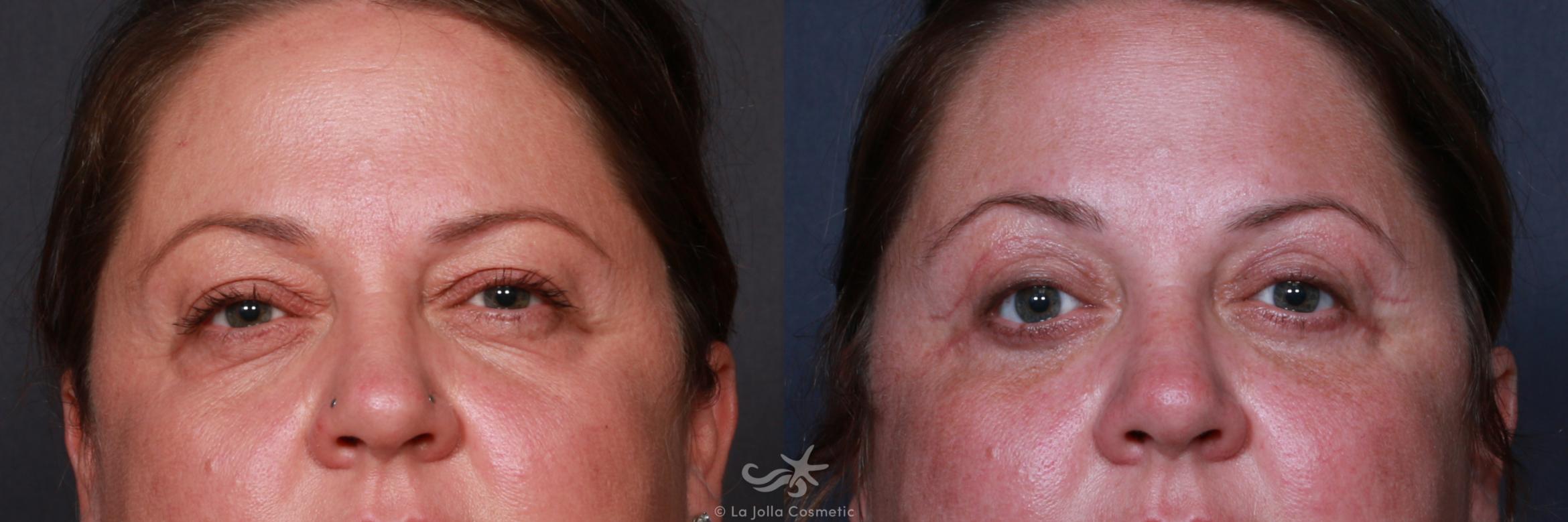 Before & After Eyelid Lift Result 192 Front View in San Diego, CA