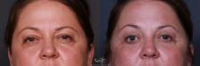 Before & After Eyelid Lift Result 192 Front View in San Diego, Carlsbad, CA