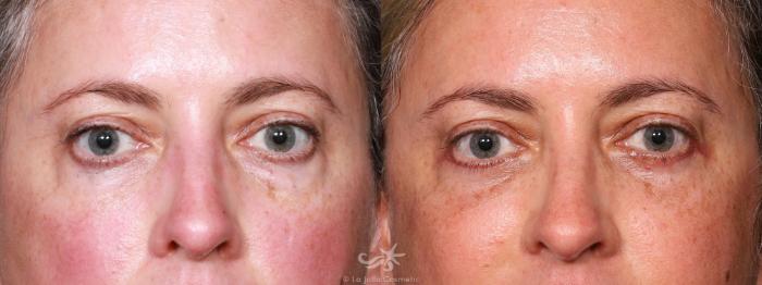 Before & After Eyelid Lift Result 646 Front View in San Diego, Carlsbad, CA