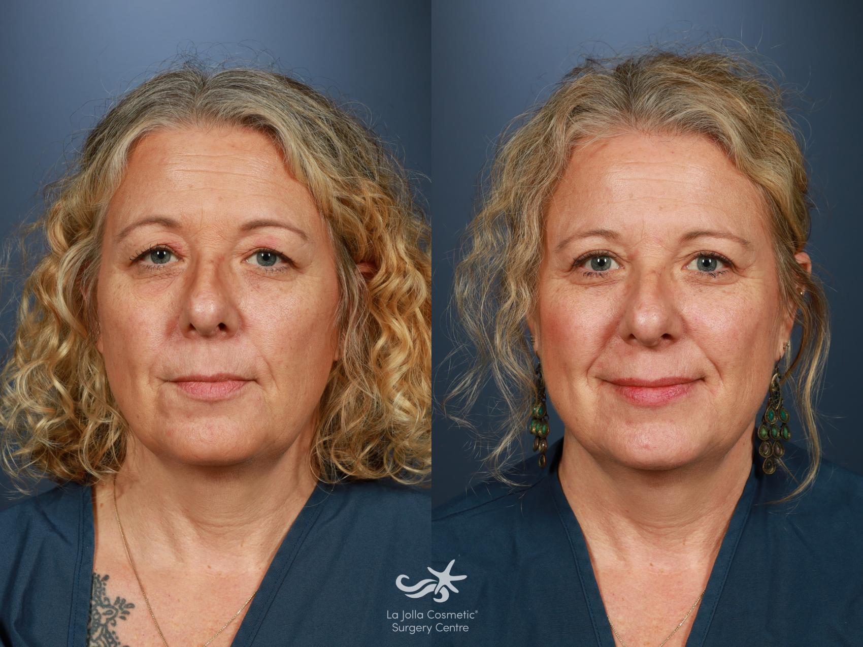 Before & After Eyelid Surgery - Upper Result 1514 Front View in San Diego, CA