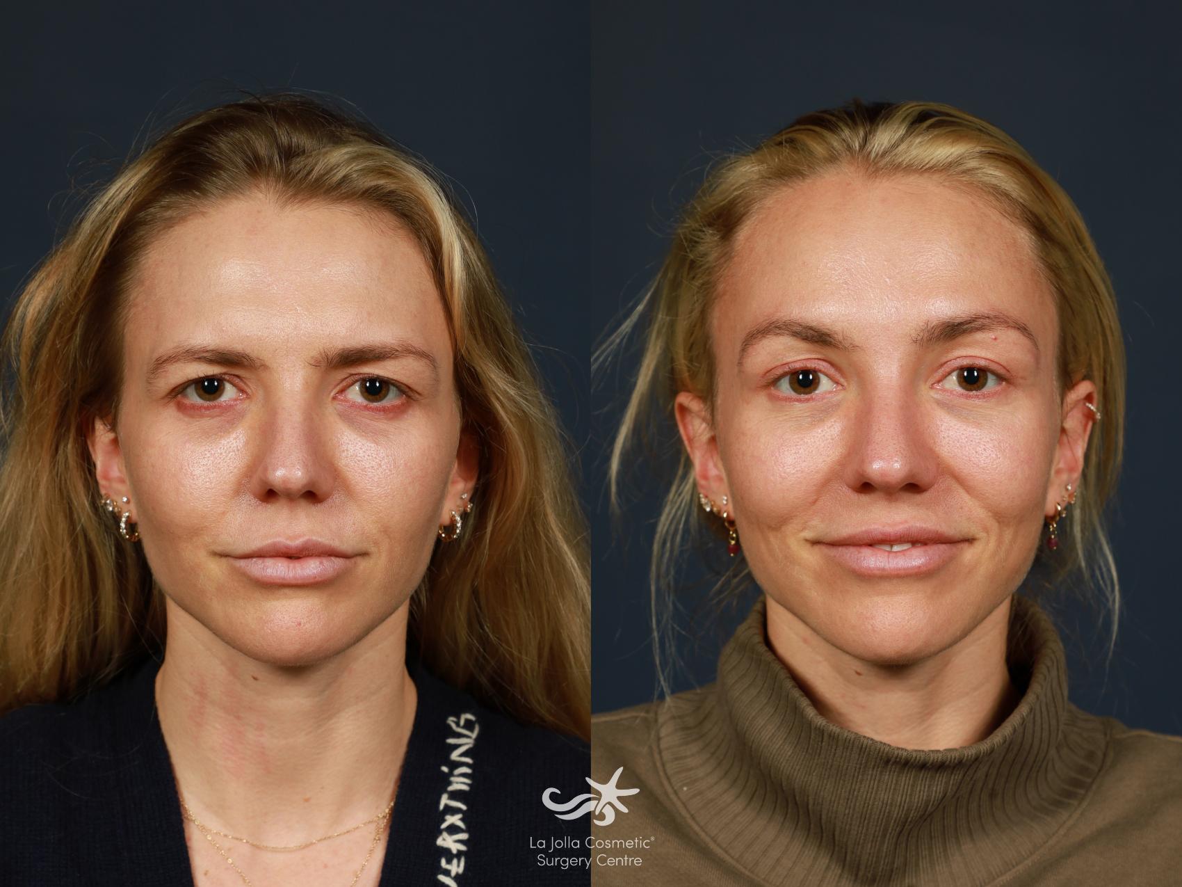 Before & After Eyelid Surgery - Upper Result 1581 Front View in San Diego, CA