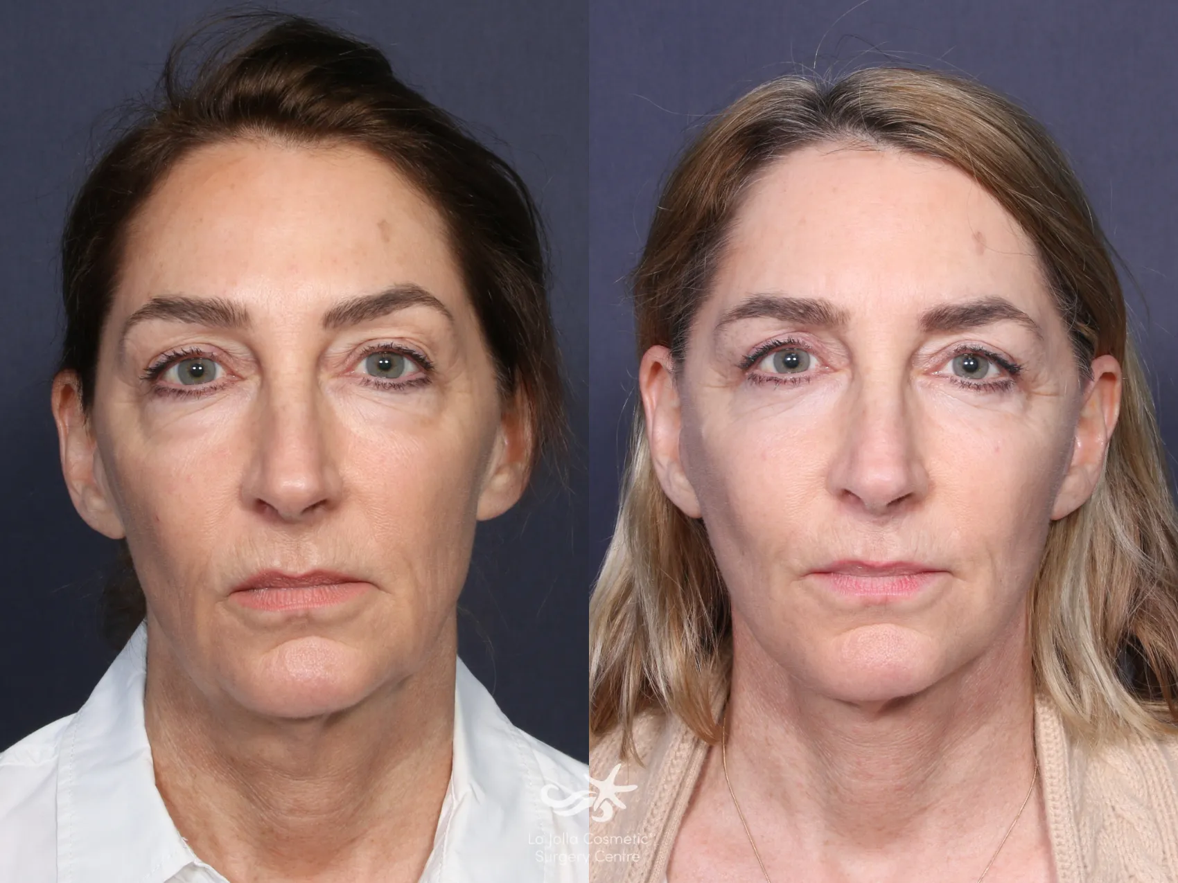 Before & After Facelift Result 121 Front View in San Diego, CA