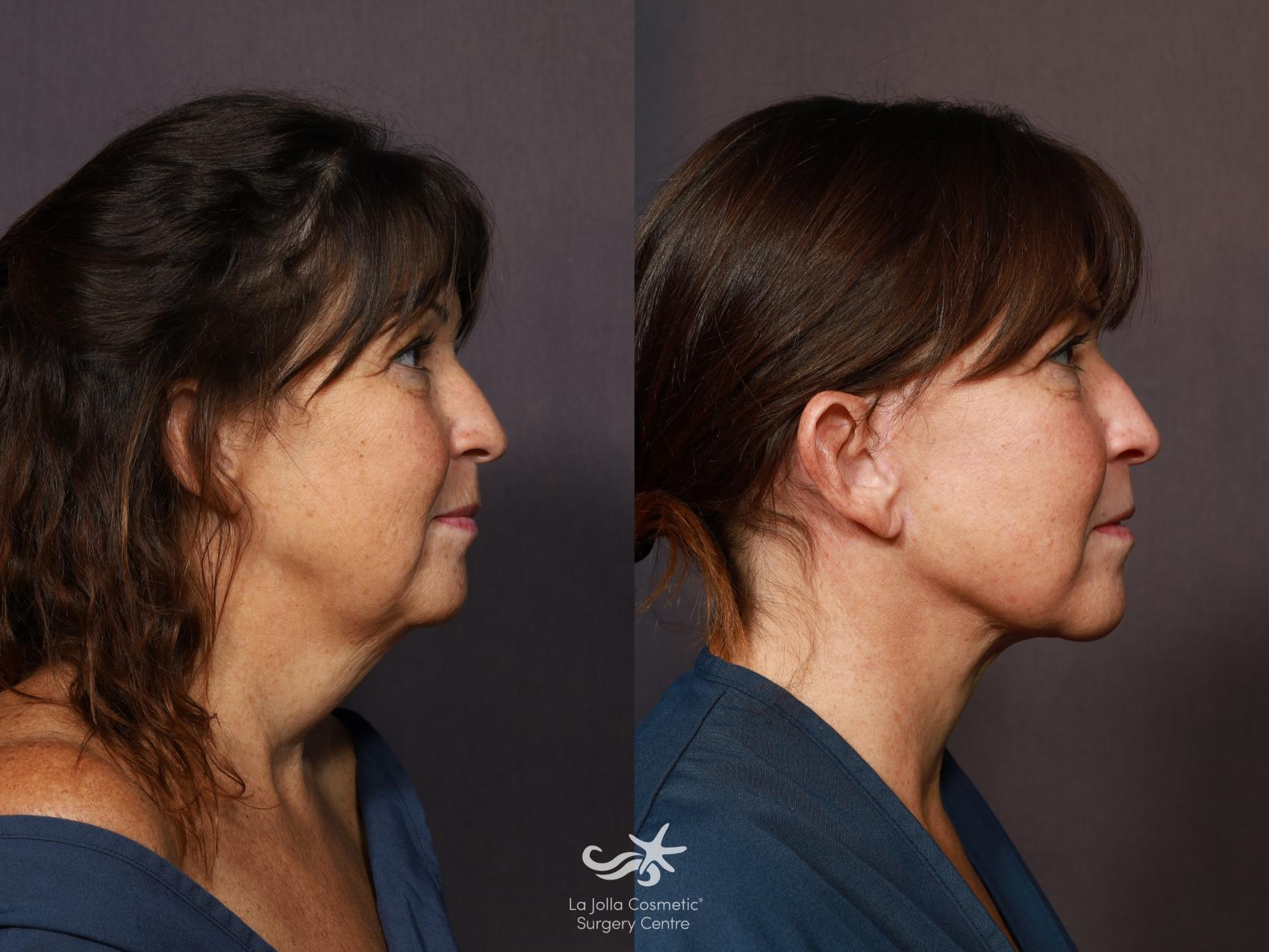 Before & After Facelift Result 1324 Right Side View in San Diego, CA