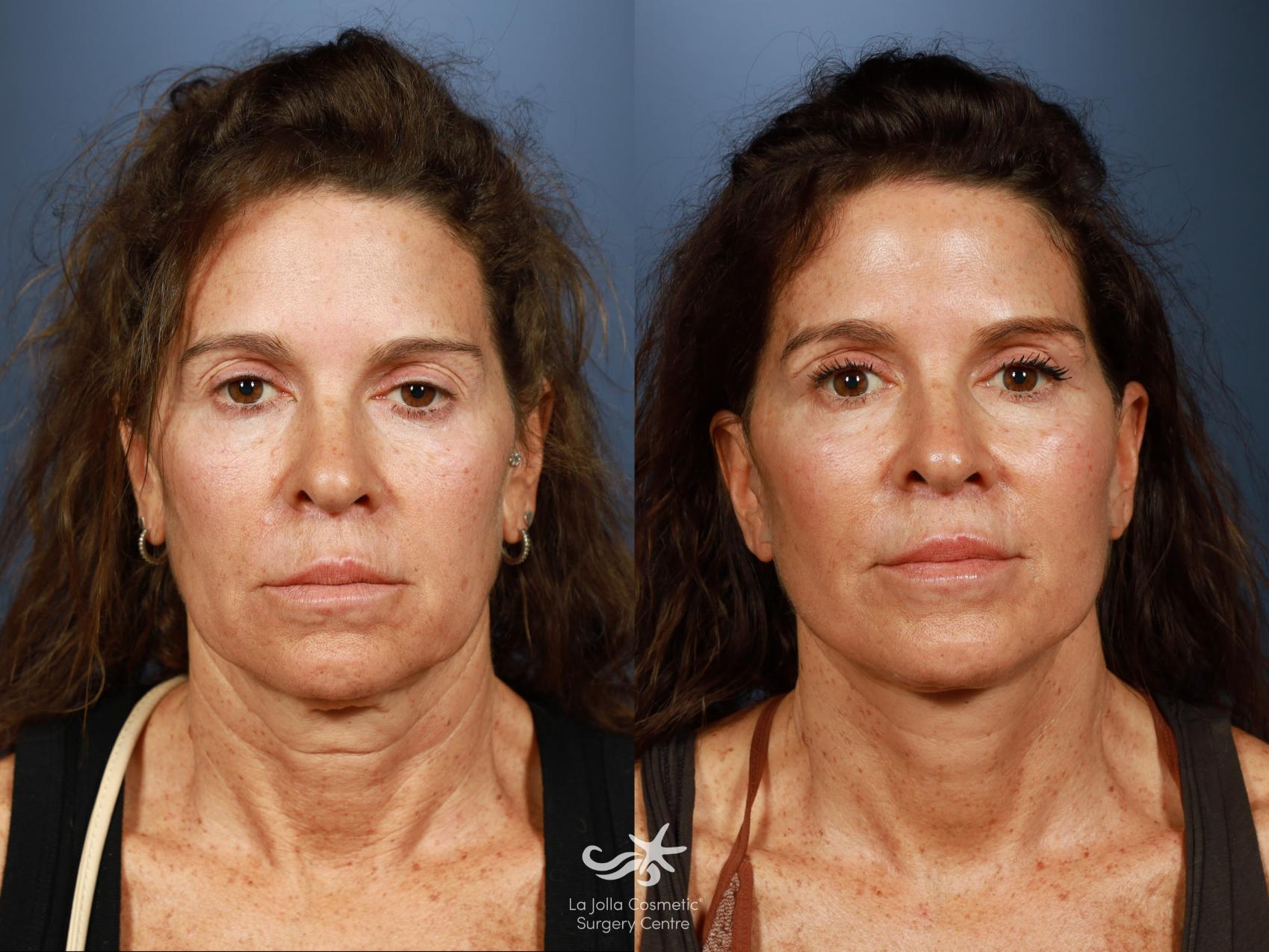 Before & After Facelift Result 1483 Front View in San Diego, CA