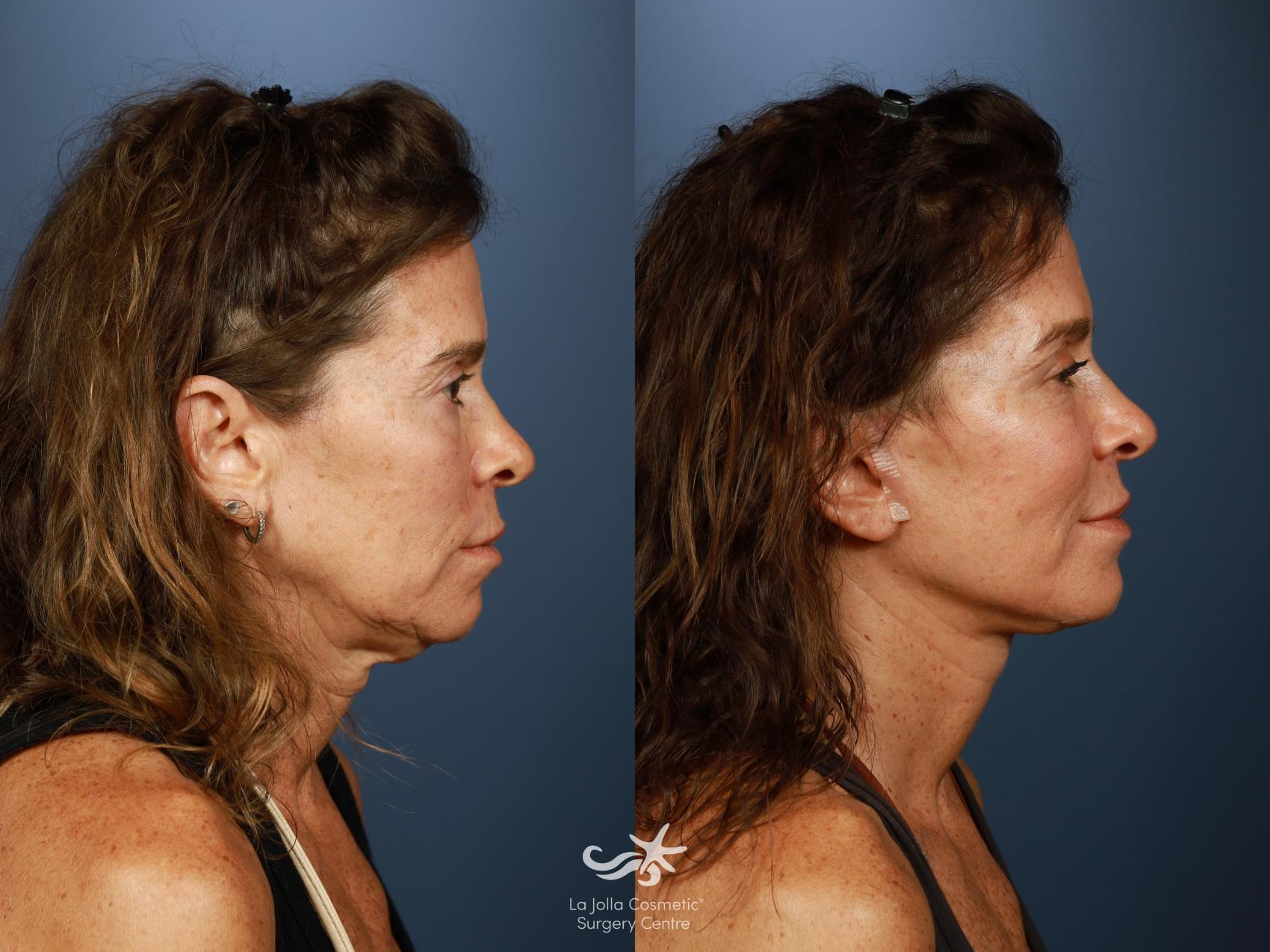 Before & After Facelift Result 1483 Right Side View in San Diego, CA