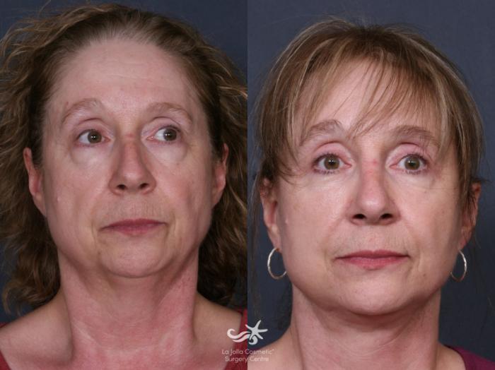 Before & After Facelift Result 284 Front View in San Diego, Carlsbad, CA
