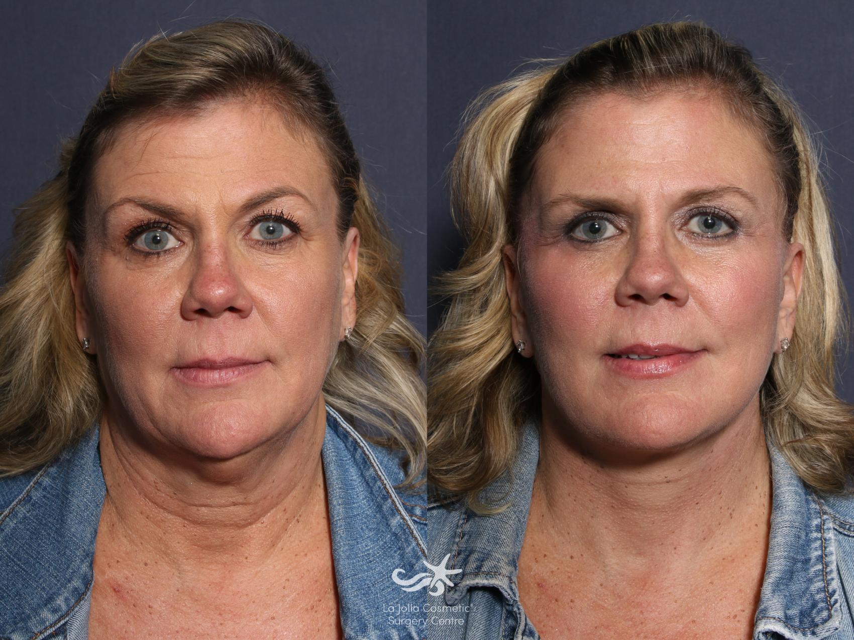 Before & After Neck Lift Result 50 Front View in San Diego, CA