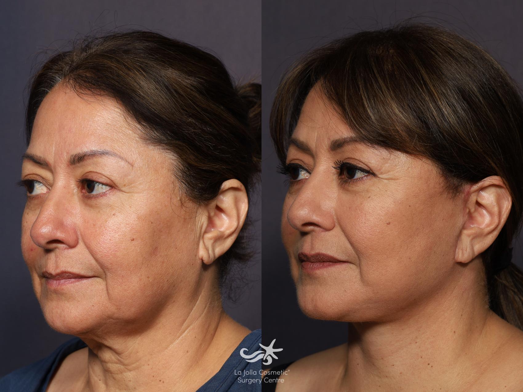 Before & After Facelift Result 862 Left Oblique View in San Diego, CA