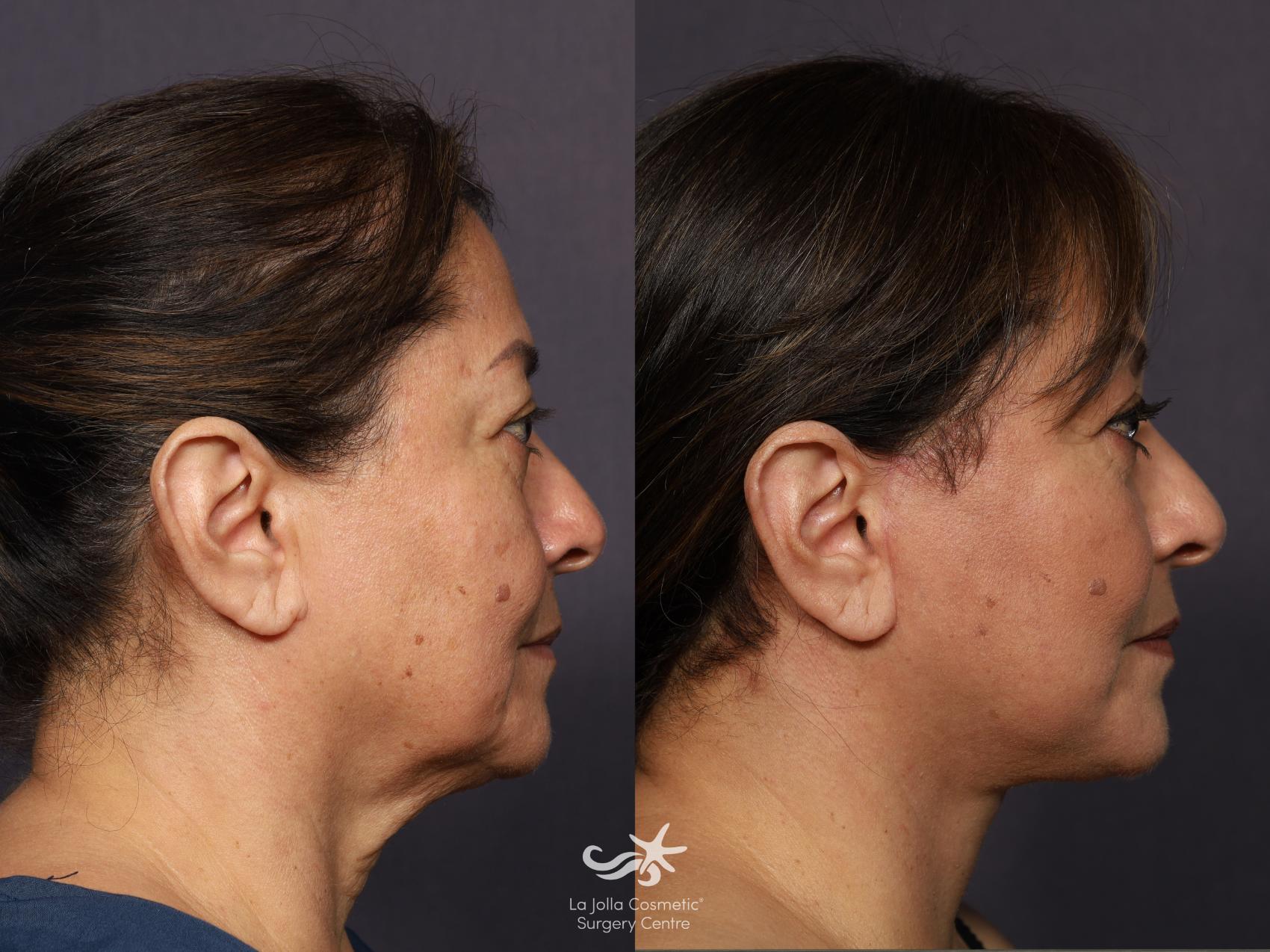 Before & After Facelift Result 862 Right Side View in San Diego, CA