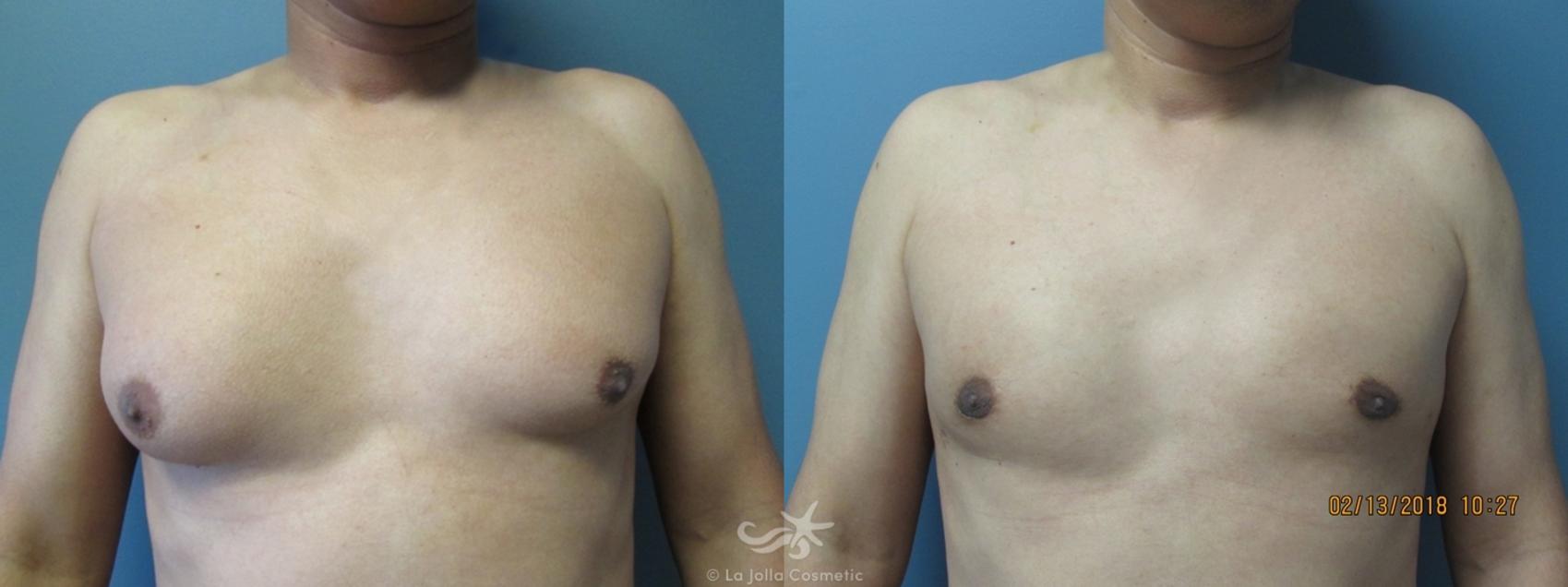 Before & After Gynecomastia Result 987 Front View in San Diego, CA
