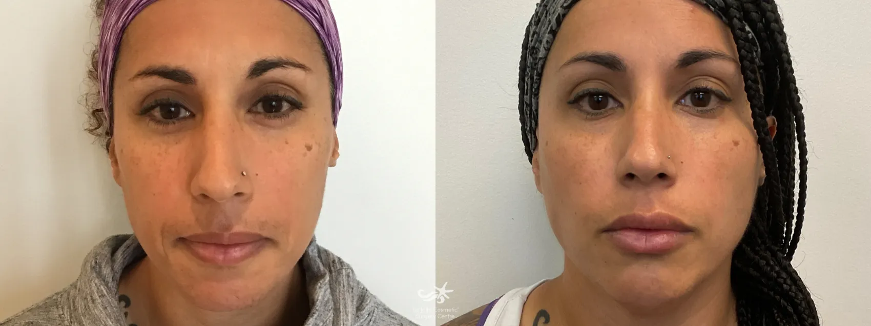 Before & After Juvéderm® Volbella™ Result 599 Front View in San Diego, CA