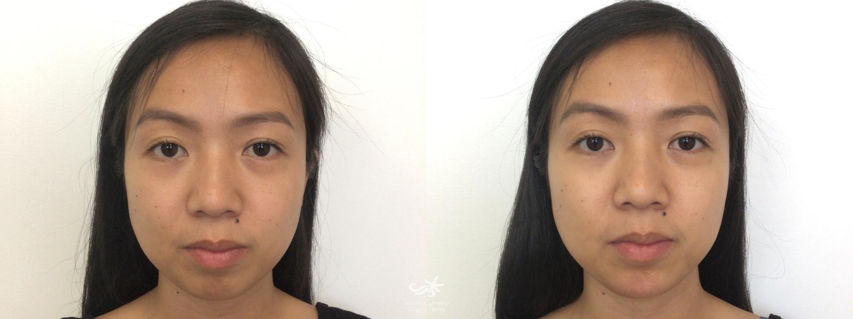Before & After JUVÉDERM® VOLUMA™ Result 128 Front View in San Diego, CA