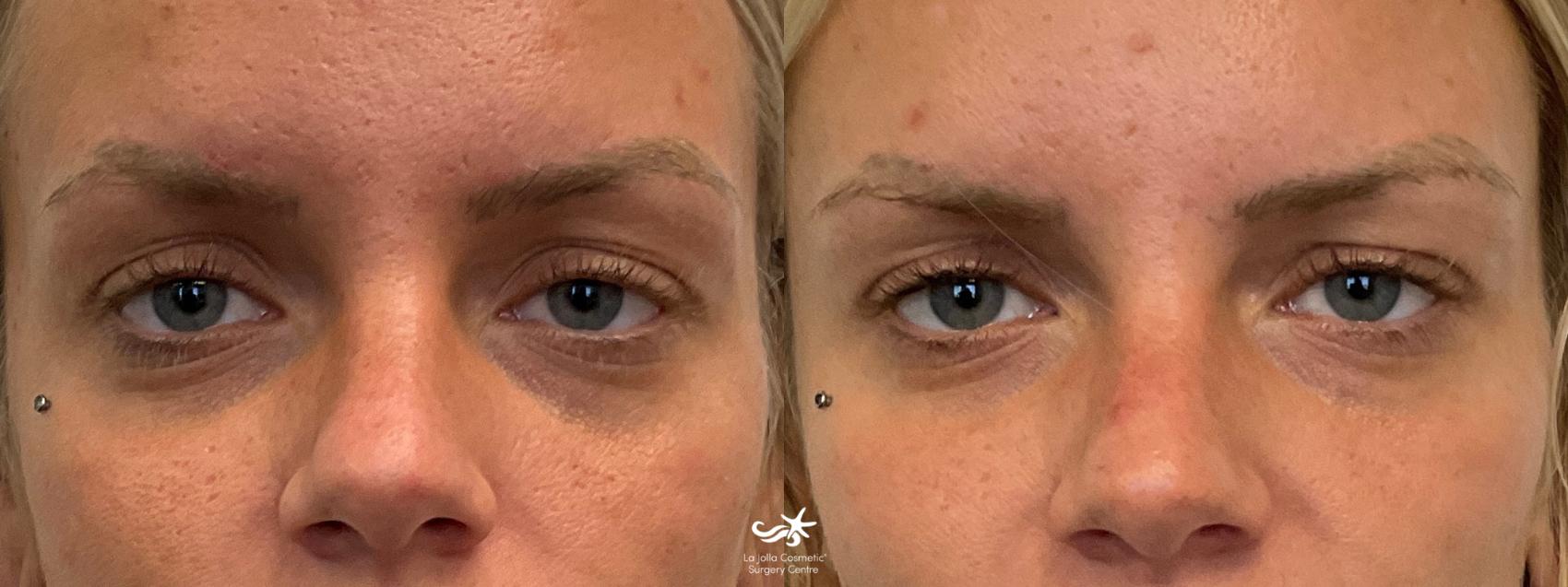 Before & After Juvéderm® Vollure™ Result 697 Front View in San Diego, CA