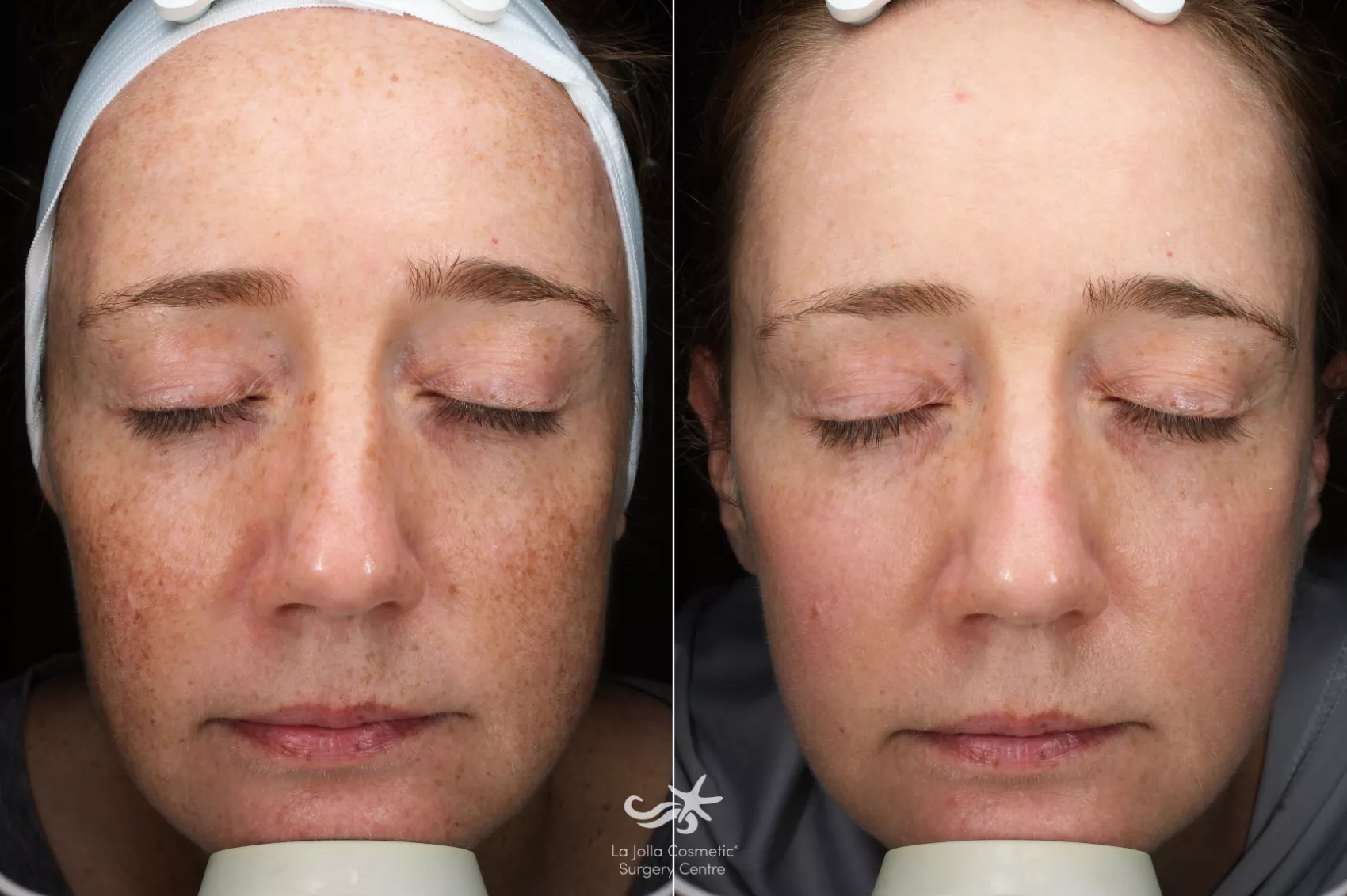 Before & After Laser Treatments Result 596 Front View in San Diego, CA