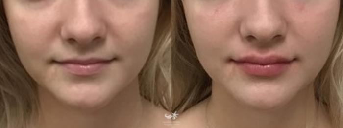 Before & After Lip Enhancement Result 119 Front View in San Diego, Carlsbad, CA