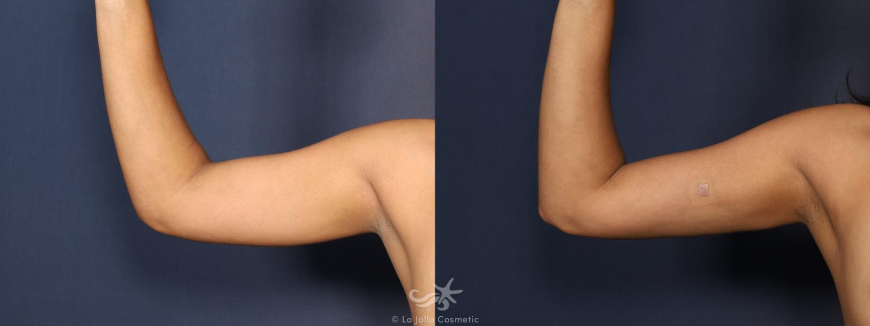 Before & After Liposuction Result 1123 Front View in San Diego, CA