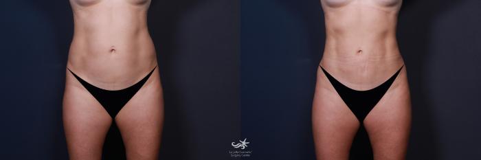 Before & After Liposuction Result 216 Front View in San Diego, Carlsbad, CA