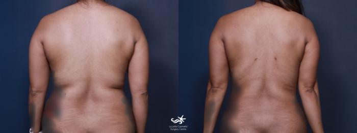 Before & After Liposuction Result 649 Back View in San Diego, Carlsbad, CA