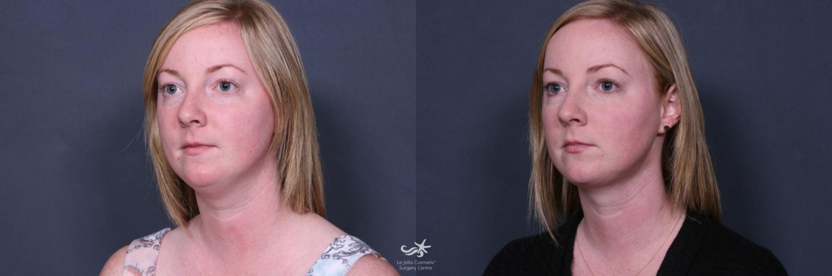 Before & After Neck Lift Result 495 Left Oblique View in San Diego, CA