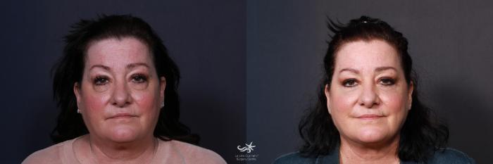 Before & After Neck Liposuction Result 595 Front View in San Diego, Carlsbad, CA
