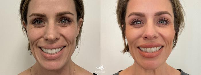 Before & After NovaThreads Result 750 Front Smile View in San Diego, Carlsbad, CA