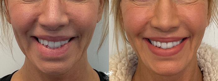 Before & After NovaThreads Result 774 Front View in San Diego, Carlsbad, CA