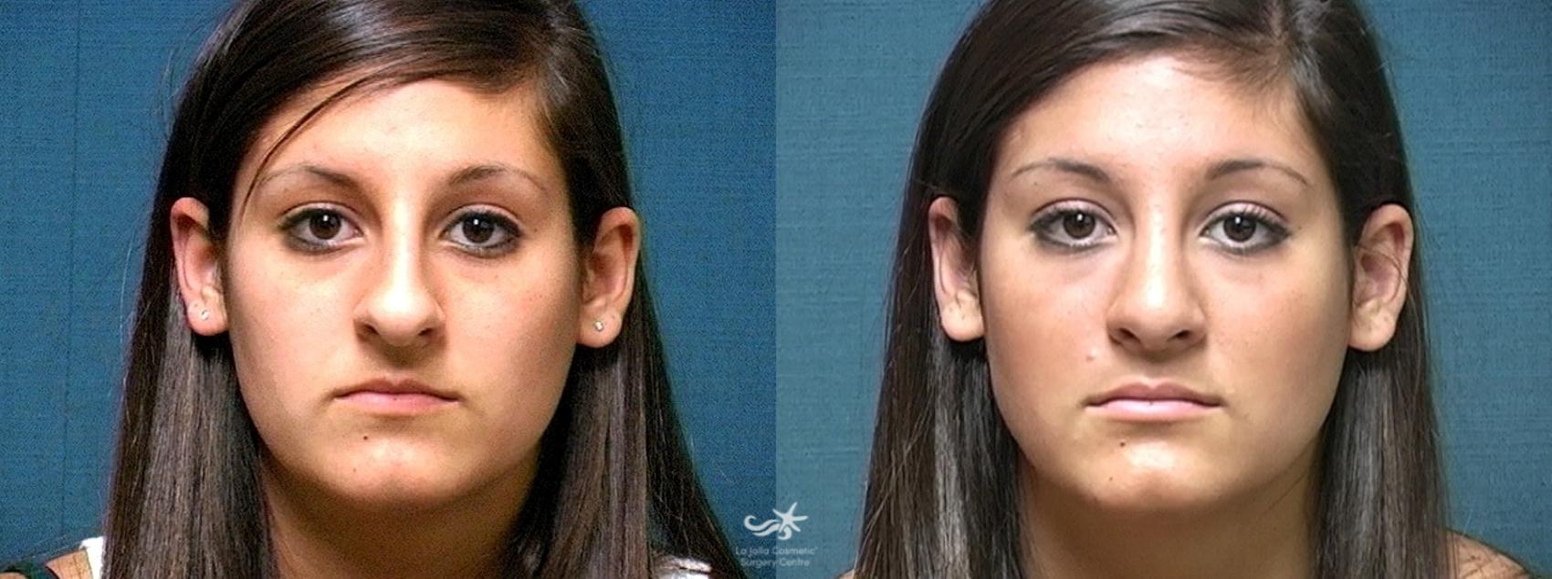 Before & After Rhinoplasty Result 506 Front View in San Diego, CA