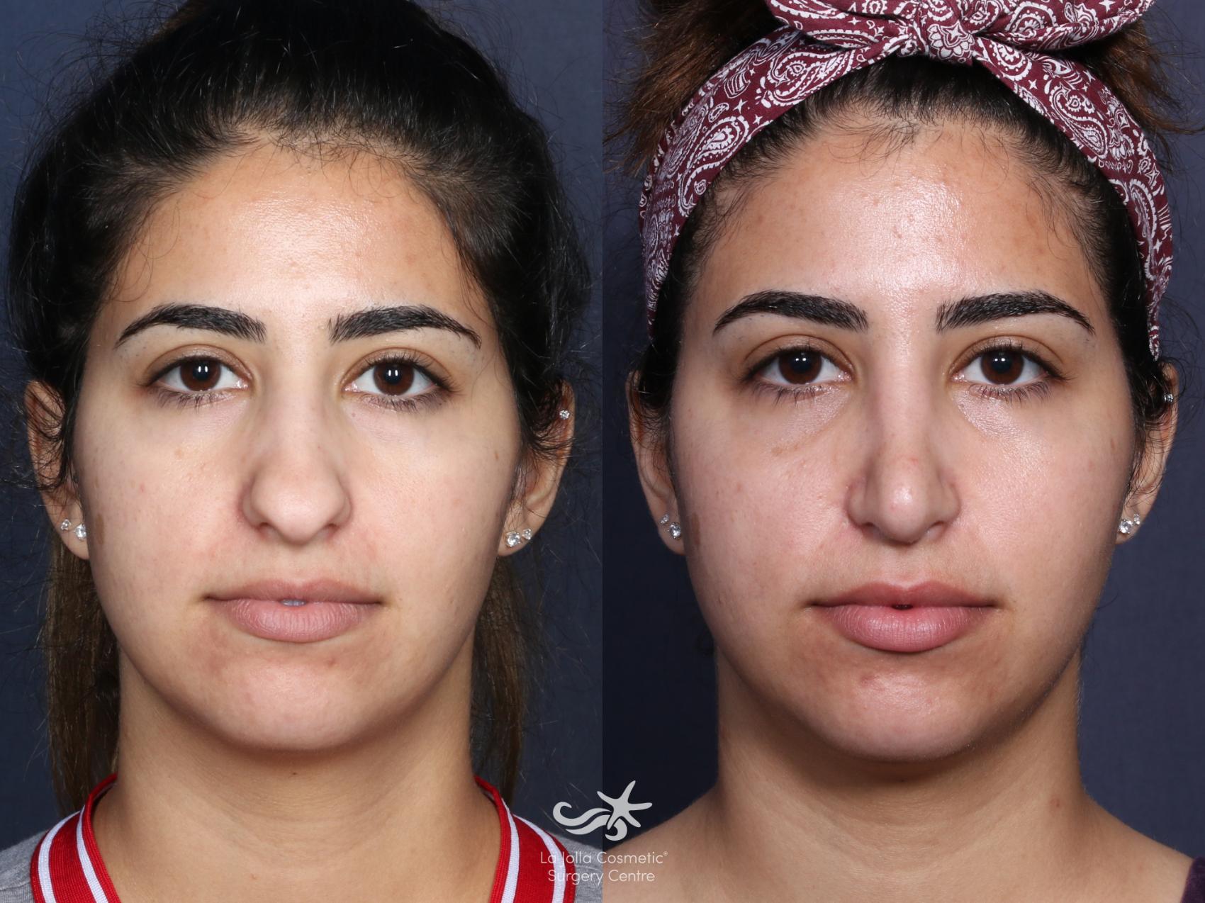Before & After Rhinoplasty Result 53 Front View in San Diego, CA